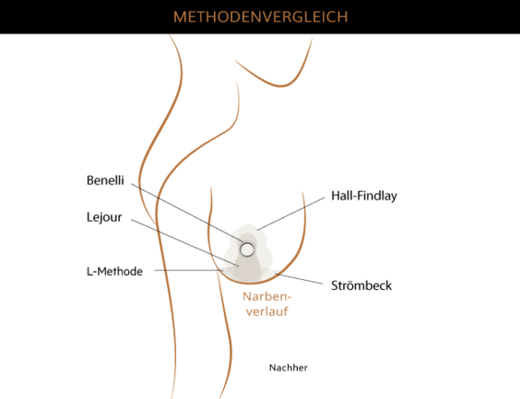 Bruststraffung Methodenvergleich, Plastische & Ästhetische Chirurgie München, AEZM