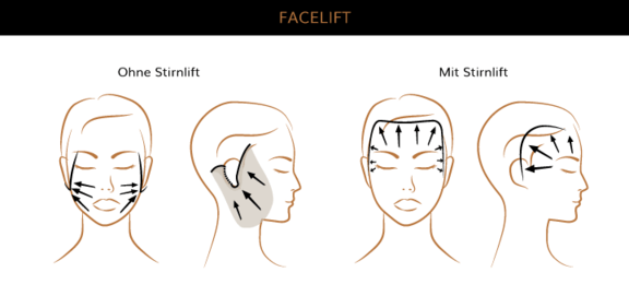 Facelift, Plastische & Ästhetische Chirurgie München, AEZM