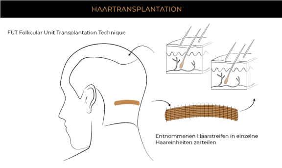 Grafik Haartransplantation FUT Methode 