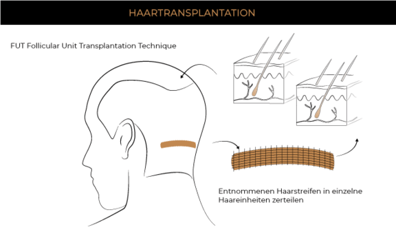 Grafik Haartransplantation FUT Methode