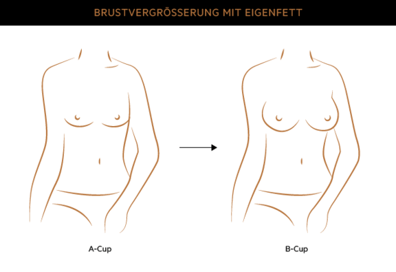 Brustvergrößerung, Plastische & Ästhetische Chirurgie München, AEZM