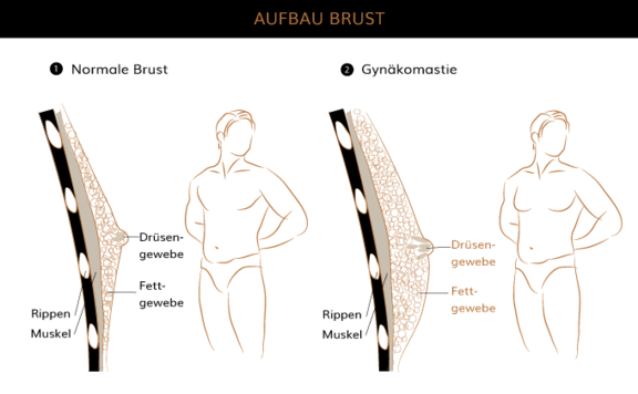 Gynäkomastie, Plastische & Ästhetische Chirurgie München, AEZM