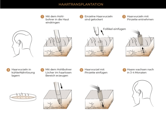 Grafik Haartransplantation FUE Methode 