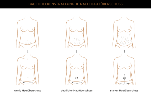 Bauchdeckenstraffung, Plastische & Ästhetische Chirurgie München, AEZM