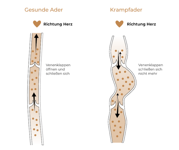Krampfadern entfernen, Plastische & Ästhetische Chirurgie München, AEZM